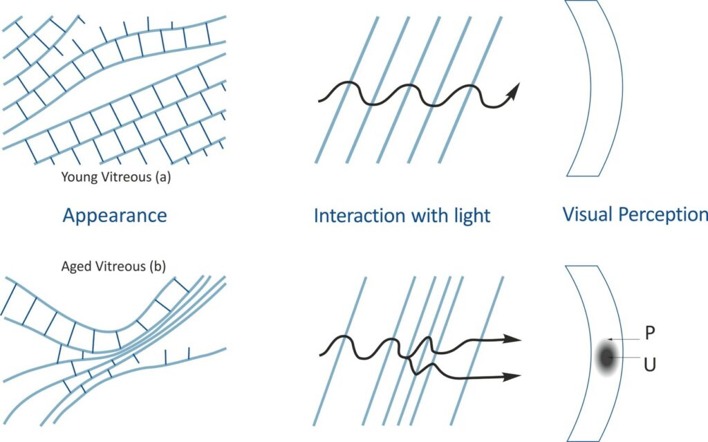 light transmission normal and degenerated vitreous