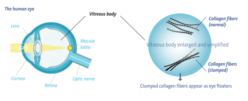 Root Cause and How to reduce floaters in eyes naturally