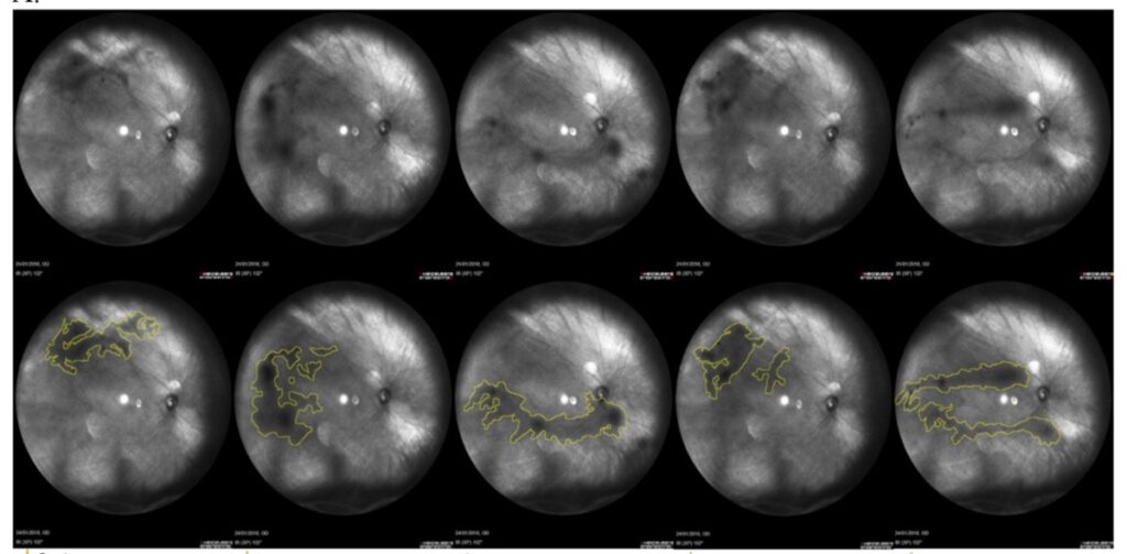 Eye Floaters capture of viterous opacity areas with Heildelberg Spectralis FLIES study